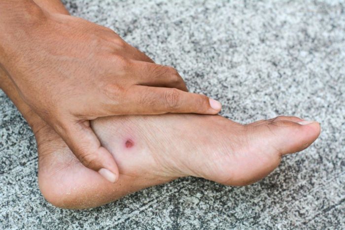 komplikacije čireva stopala dijabetesa