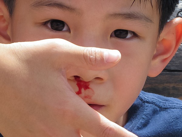 krvarenje iz nosa kod djece
