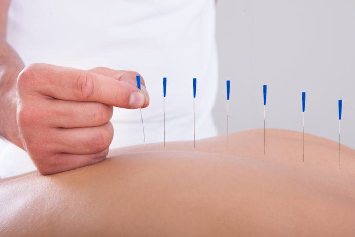 akupunktura ublažava bol