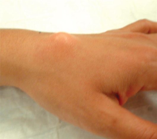 Gornja gesta gornjeg zgloba (izvor: Američko društvo za kirurgiju ruku)