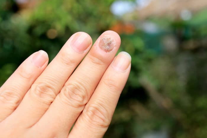 gljivične infekcije nokta