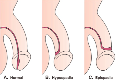 rupa u penisu nije normalna, epizode hipospadije