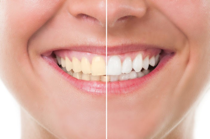 Nuspojave izbjeljivanja zubi s izbjeljivanjem