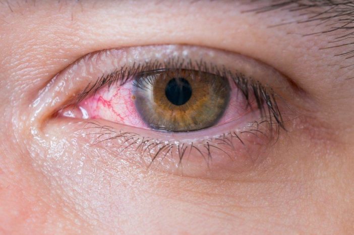 alergijski konjuktivitis crvenih očiju
