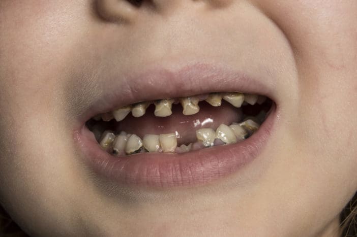 kvarenje zubi dječje bočice za dječje zubne karijere