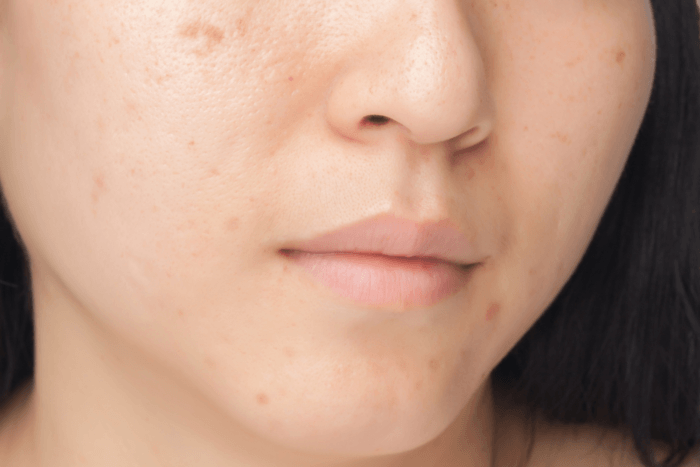 metoda uklanjanja ožiljaka na licu