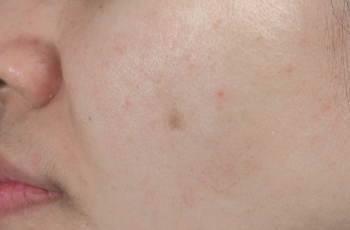 kako da biste dobili osloboditi od acne ožiljaka crne točke