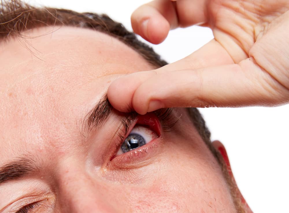disketni kapci spušteni sindrom očne kapke