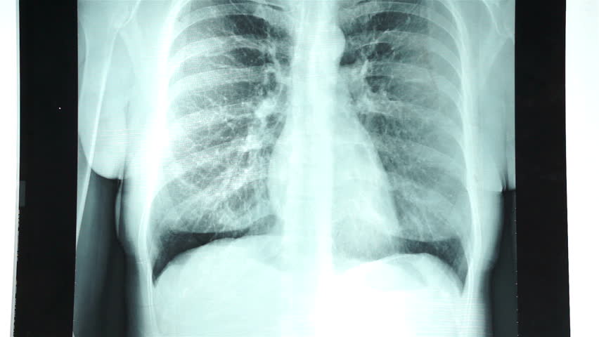 rendgenski snimak prsnog koša