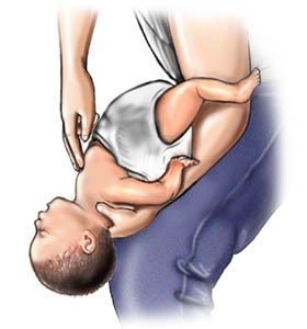Koraci za pomoć pri gušenju beba (4-5) izvor: www.webmd.com