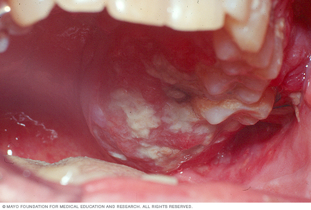 oralni karcinom
