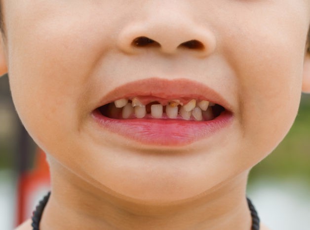 oštećenja dječjih zuba
