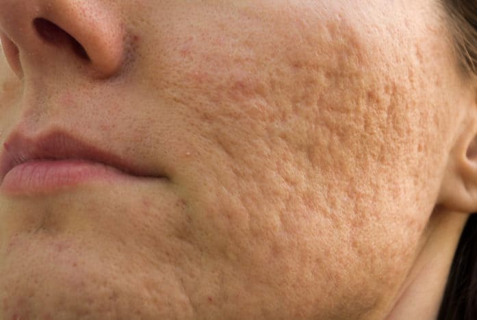 kako da biste dobili osloboditi od pockmark acne ožiljaka