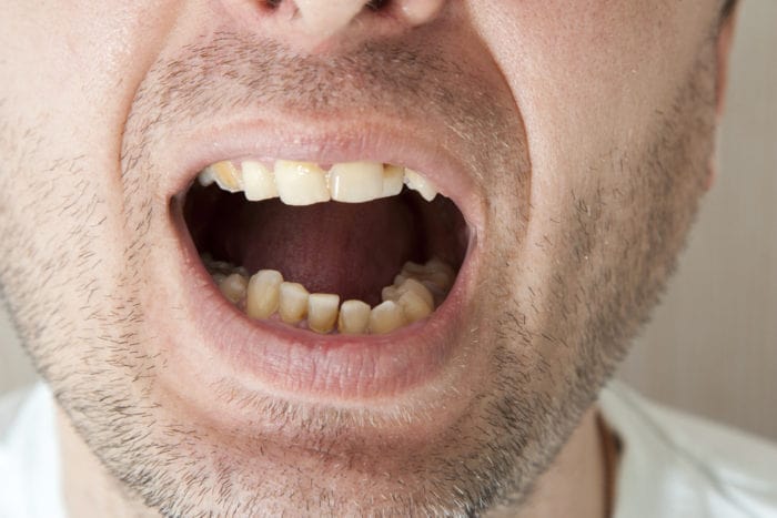 kako spriječiti zubni kamenac