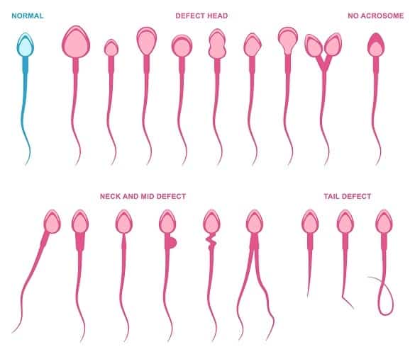 abnormalnosti sperme