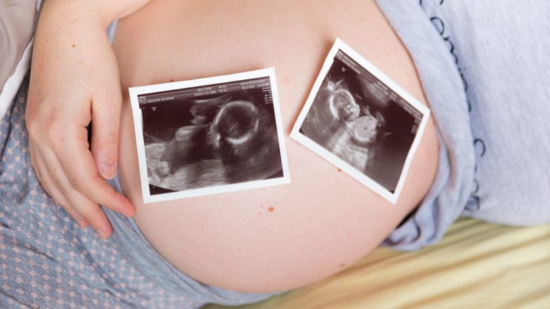 rizik od trudnoće s blizancima nestaje