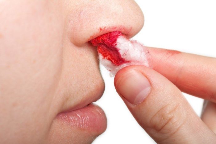 uzroci krvarenja iz nosa, krvarenje iz nosa kod djece, krvarenje iz nosa, naglo krvarenje iz nosa